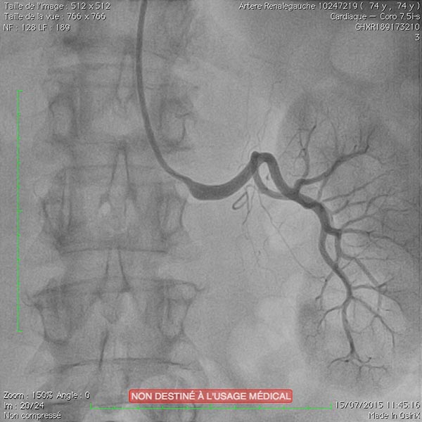 Angiographie rénale gauche